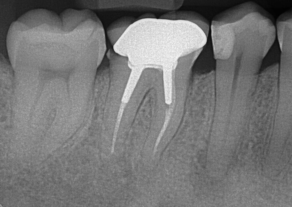 Traitement de canal (endodontie)