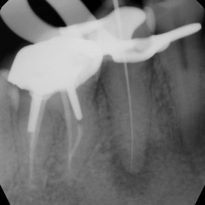 Traitement de canal (endodontie)